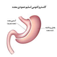 اسلیو معده اسلیو معده